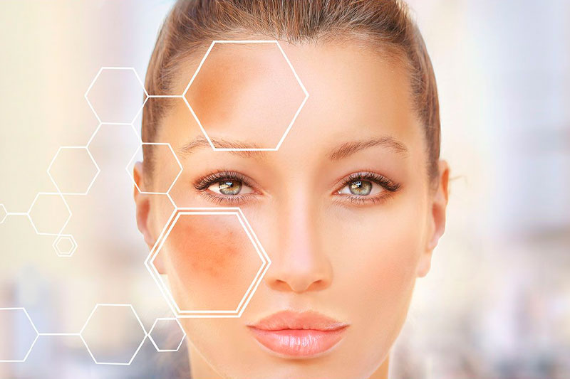 melasma